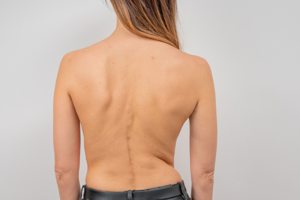 Scoliosis